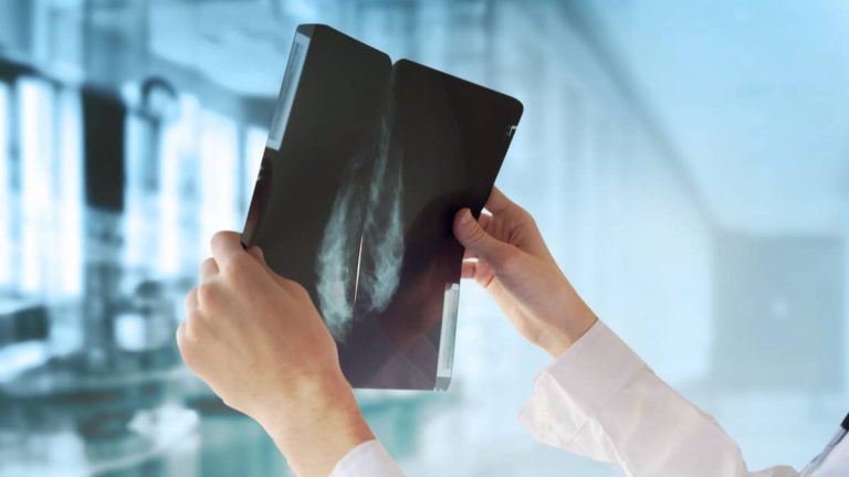 Inteligencia artificial supera medicos no diagnostico de cancer de mama